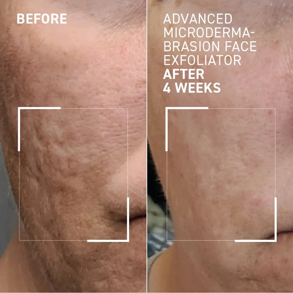 Dr. Brandt Advanced Microdermabrasion Face Exfoliator | NIB